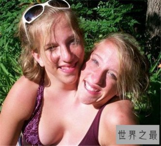 ​连体婴儿长什么样 曾有连体婴儿成功做完手术