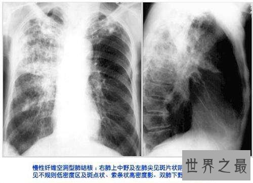 肺部纤维化病因原由介绍 症状以及治疗方法介绍